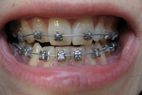 wire on teeth