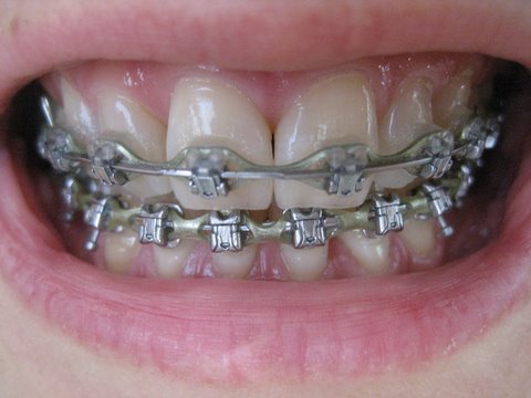 braces with springs